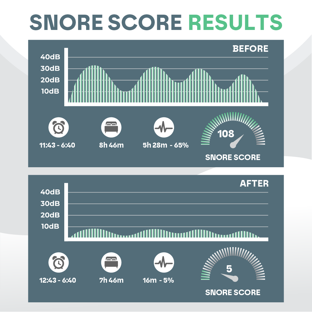 Sleep Guard Pro Mouth Guard for Anti-Grinding & Jaw Protection